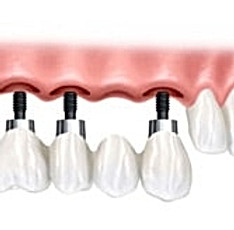 clinicas ortodoncia cali Dr. Juan Tobar Odontología - Diseño de Sonrisa y Relleno de labios con Acido Hialuronico