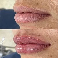 clinicas ortodoncia cali Dr. Juan Tobar Odontología - Diseño de Sonrisa y Relleno de labios con Acido Hialuronico