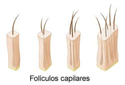 clinicas injerto capilar cali Transplante de Pelo en Cali