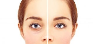 Blepharoplasty