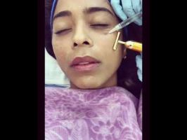 Nutrición Facial con Ácido Hialuronico