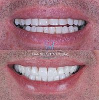 clinicas dentales en cali Dr. Juan Tobar Odontología - Diseño de Sonrisa y Relleno de labios con Acido Hialuronico