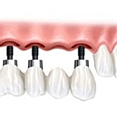 clinicas dentales en cali Dr. Juan Tobar Odontología - Diseño de Sonrisa y Relleno de labios con Acido Hialuronico